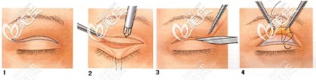 全切双眼皮手术的原理 全切双眼皮手术的原理