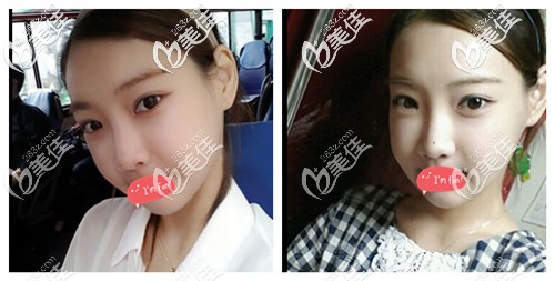 内双割双眼皮后恢复过程虽然有点难熬，但是看到40天恢复图觉得很欣慰