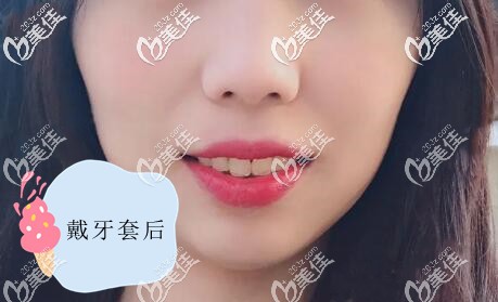 亮出我凸嘴带金属自锁牙套矫正前后对比照,妞们来瞅瞅我这正畸效果如何吧