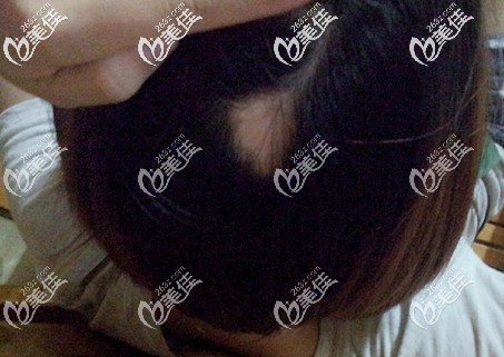 头顶出现了一块斑秃咋办 头顶出现了一块斑秃咋办