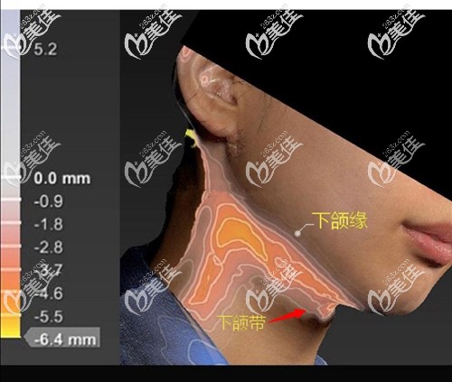 颈部吸脂的位置 颈部吸脂的位置