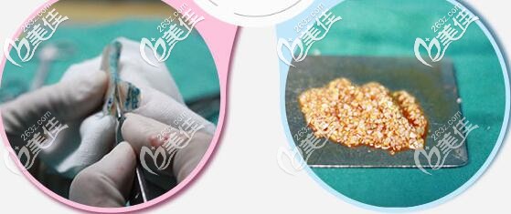 自体软骨鼻基底填充