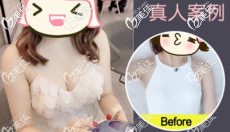 傲诺拉225cc假体隆胸一年后效果图