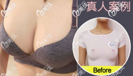 傲诺拉璀璨水滴形225cc假体隆胸6个月前后对比照片