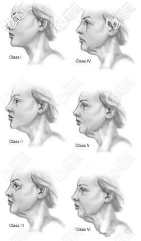颈部下垂程度 颈部下垂程度