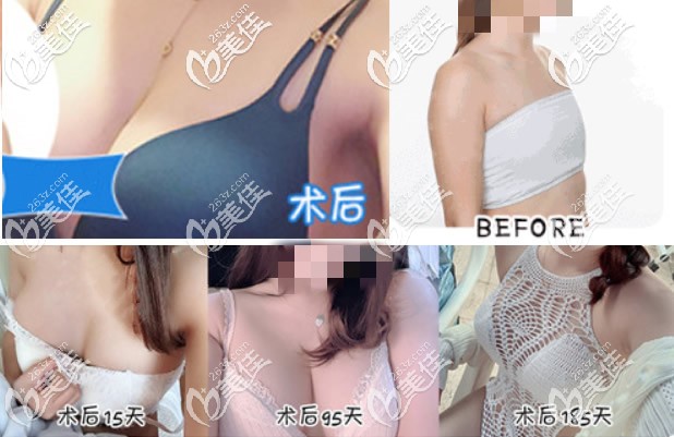 曼托假体隆胸前后对比照片 曼托假体隆胸前后对比照片