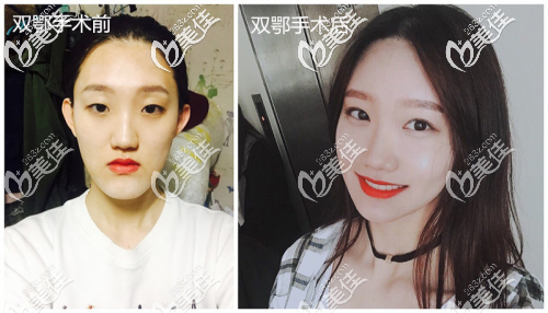 双鄂手术前后对比案例