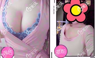 曼托假体隆胸两年恢复图 曼托假体隆胸两年恢复图