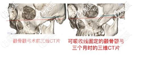 做完微创颧骨颧弓降低术后三个月ct图 做完微创颧骨颧弓降低术后三个月ct图