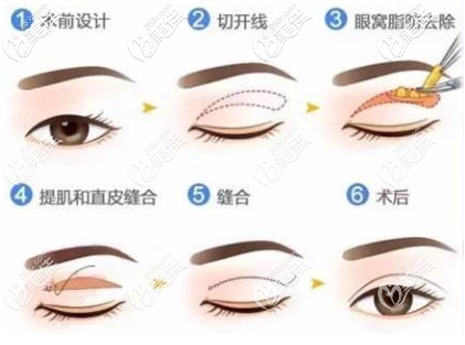 切开双眼手术原理 切开双眼手术原理