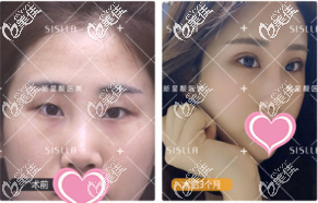 北京新星靓医疗美容医院原生双眼皮真人案例 北京新星靓医疗美容医院原生双眼皮真人案例