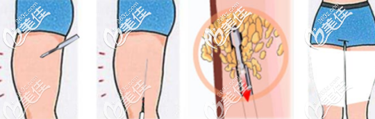 大腿吸脂过程示意图 大腿吸脂过程示意图