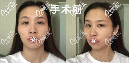 术前照