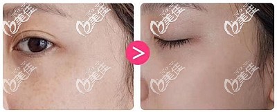 用英诺小棕瓶3次以后的改善效果 用英诺小棕瓶3次以后的改善效果