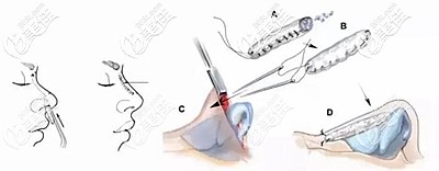 肋软骨隆鼻的原理 肋软骨隆鼻的原理