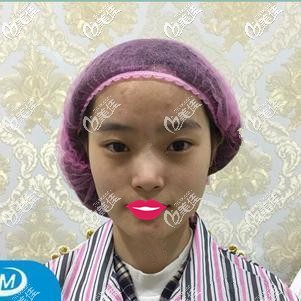 术前面部皮肤松弛下垂显老 术前面部皮肤松弛下垂显老