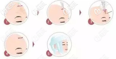 泰国整形做SMAS除皱术过程 泰国整形做SMAS除皱术过程