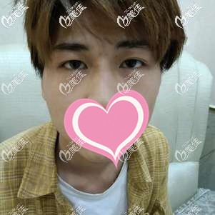 埋线重睑术后6个月大小眼不对称 埋线重睑术后6个月大小眼不对称