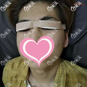 全切双眼皮修复术后即刻 全切双眼皮修复术后即刻