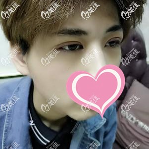 眼修复7天到院拆线依旧肿胀 眼修复7天到院拆线依旧肿胀