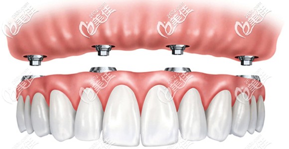 全口半固定和全固定种植牙的区别 全口半固定和全固定种植牙的区别