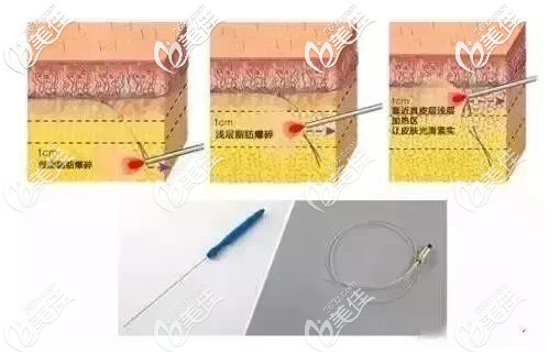 光纤溶脂的原理 光纤溶脂的原理