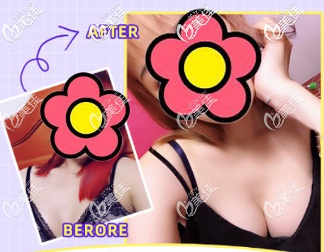 麦格水滴形235假体隆胸一年后效果图 麦格水滴形235假体隆胸一年后效果图