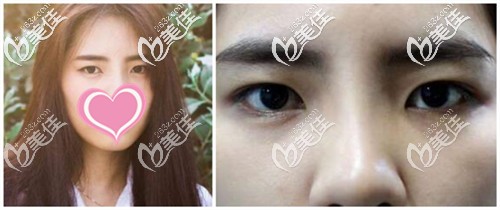 双眼皮手术前 双眼皮手术前