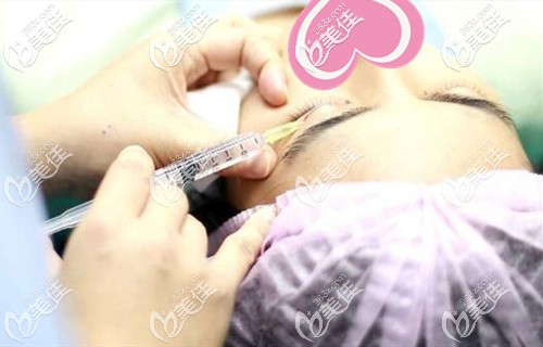 双眼皮手术注射麻药 双眼皮手术注射麻药