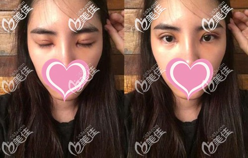 双眼皮手术后恢复一周 双眼皮手术后恢复一周