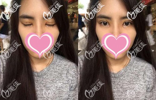 双眼皮手术后恢复半个月 双眼皮手术后恢复半个月