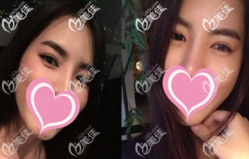 双眼皮手术后恢复半年 双眼皮手术后恢复半年