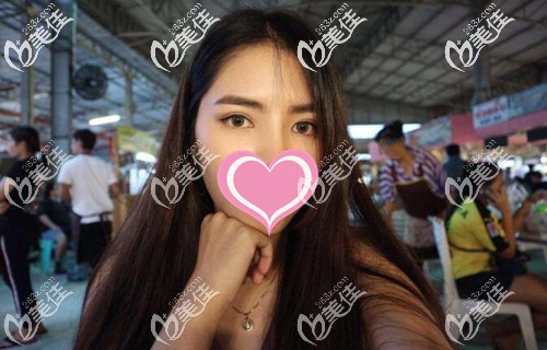 泰国曼谷的马斯特皮整形做完双眼皮术后8个月发现我竟然也可以这么美