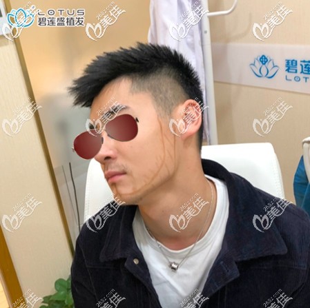 术前设计种植方案 术前设计种植方案