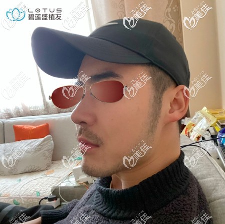 术后一个月遇上了植胡须后的脱落期 术后一个月遇上了植胡须后的脱落期