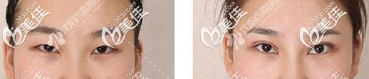 沈阳百嘉丽侯亚杰做双眼皮真人前后对比案例图 沈阳百嘉丽侯亚杰做双眼皮真人前后对比案例图