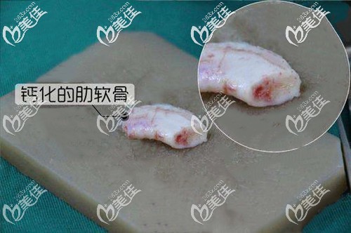 朋友发给我的钙化肋软骨