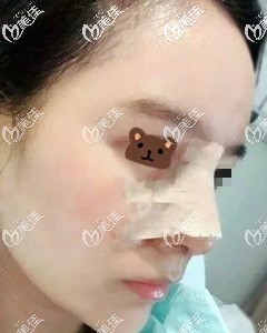 肋软骨隆鼻术后即刻效果