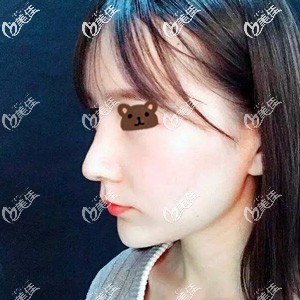 隆鼻术后12天鼻子挺拔但僵硬