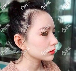 肋软骨隆鼻30天疤痕渐消