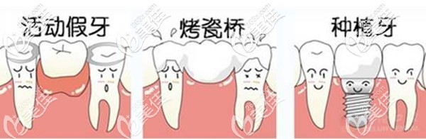 活动假牙和烤瓷牙以及种植牙图解 活动假牙和烤瓷牙以及种植牙图解