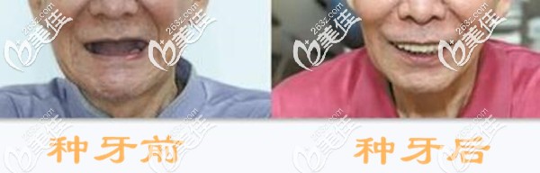 我在郑州金水区做全口种植牙效果
