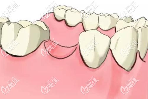 牙齿缺失外观图