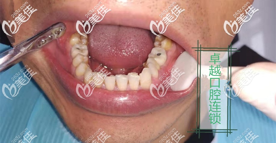 金水区牙科种植牙案例