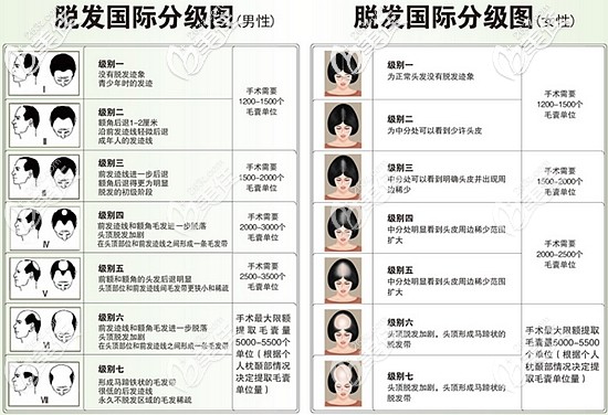 男士女士脱发分级图 男士女士脱发分级图