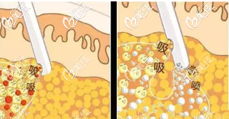 水动力吸脂技术原理