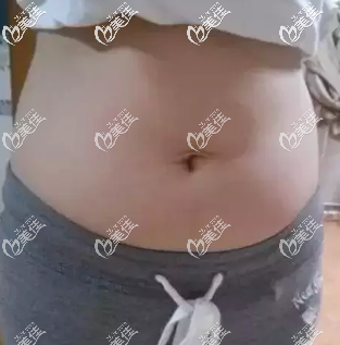 我做腰腹水动力吸脂术前照片
