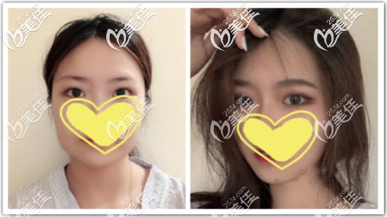 做完面部光纤溶脂三个月效果对比图 做完面部光纤溶脂三个月效果对比图