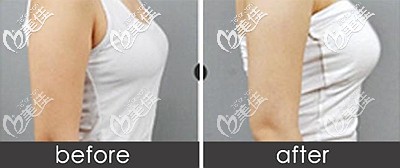 做麦格假体隆胸后的效果对比