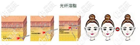 光纤溶脂原理示意图 光纤溶脂原理示意图